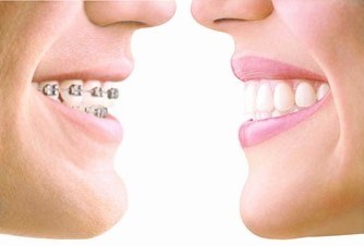 VA-Invisalign